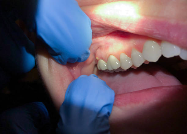 Best Emergency Treatment for Dental Infections or Abscesses in Burke, VA