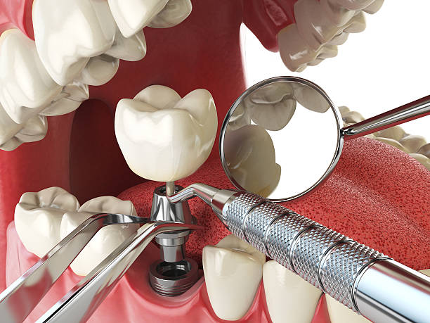 Best Emergency Treatment for Dental Infections or Abscesses in Burke, VA